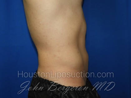 Liposuction Before & After Patient #3366