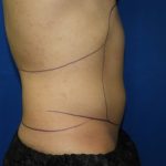 Liposuction Before & After Patient #3366