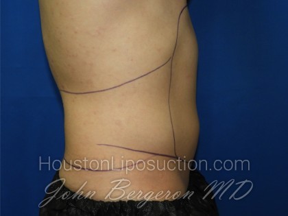 Liposuction Before & After Patient #3366