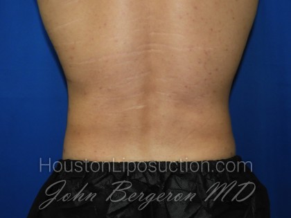 Liposuction Before & After Patient #3366