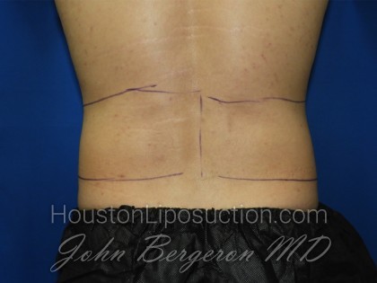 Liposuction Before & After Patient #3366