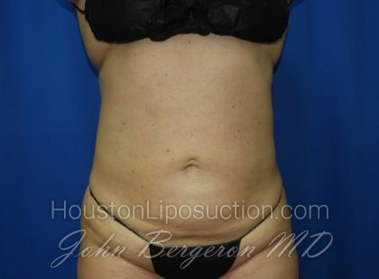 Liposuction Before & After Patient #3375