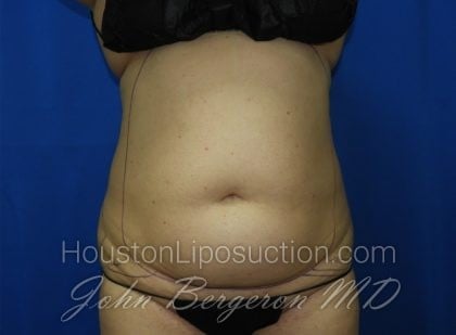 Liposuction Before & After Patient #3375