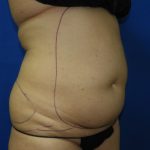 Liposuction Before & After Patient #3375