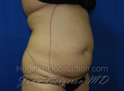 Liposuction Before & After Patient #3375