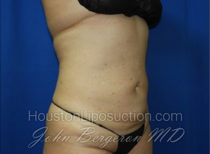 Liposuction Before & After Patient #3375