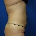 Liposuction Before & After Patient #3375