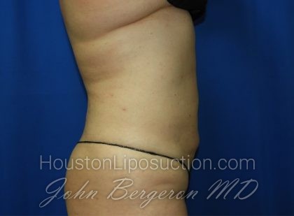 Liposuction Before & After Patient #3375