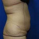 Liposuction Before & After Patient #3375