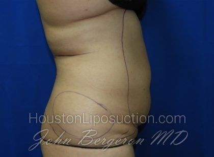 Liposuction Before & After Patient #3375