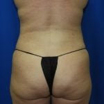 Liposuction Before & After Patient #3375