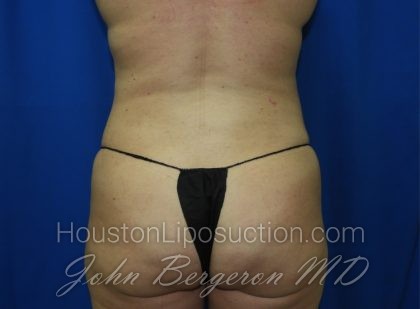 Liposuction Before & After Patient #3375