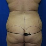 Liposuction Before & After Patient #3375