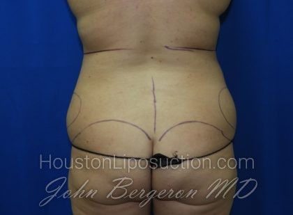 Liposuction Before & After Patient #3375