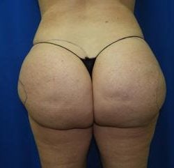 Liposuction Before & After Patient #3389