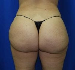 Liposuction Before & After Patient #3389