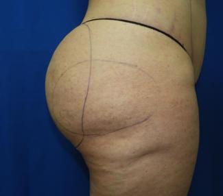 Liposuction Before & After Patient #3389