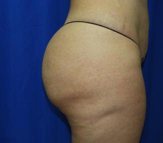 Liposuction Before & After Patient #3389