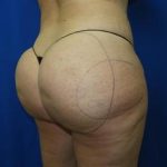 Liposuction Before & After Patient #3389