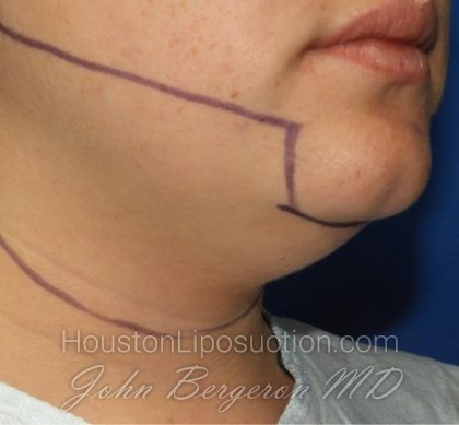 Liposuction Before & After Patient #3412