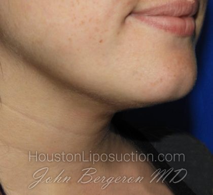 Liposuction Before & After Patient #3412