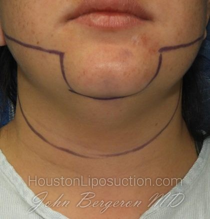 Liposuction Before & After Patient #3412