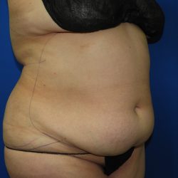 Liposuction Before & After Patient #3428
