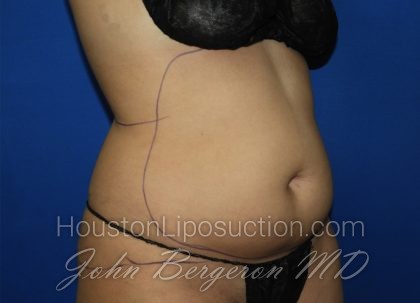 Liposuction Before & After Patient #3447