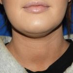 Liposuction Before & After Patient #3568