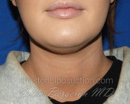 Liposuction Before & After Patient #3568