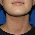 Liposuction Before & After Patient #3568