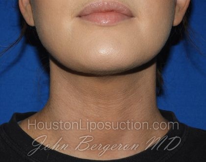 Liposuction Before & After Patient #3568
