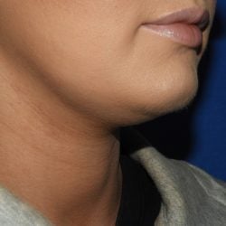 Liposuction Before & After Patient #3568