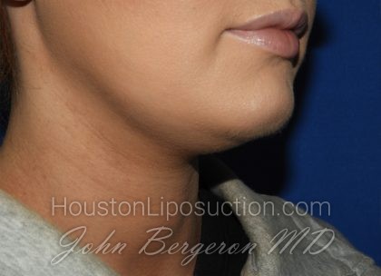 Liposuction Before & After Patient #3568