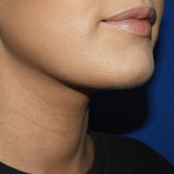 Liposuction Before & After Patient #3568