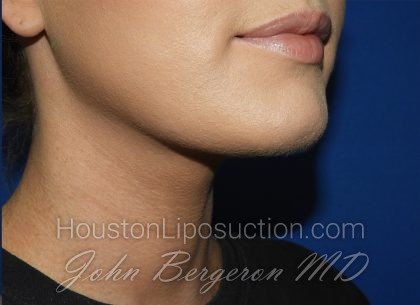 Liposuction Before & After Patient #3568