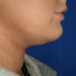 Liposuction Before & After Patient #3568