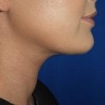 Liposuction Before & After Patient #3568