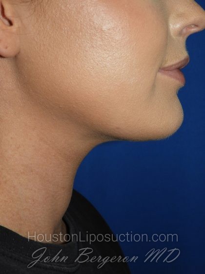 Liposuction Before & After Patient #3568