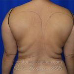 Arms Before & After Patient #3603