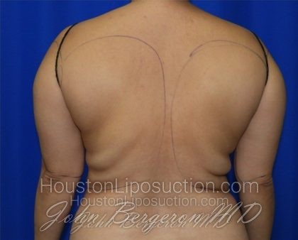 Arms Before & After Patient #3603
