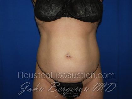 Abdomen Before & After Patient #3639