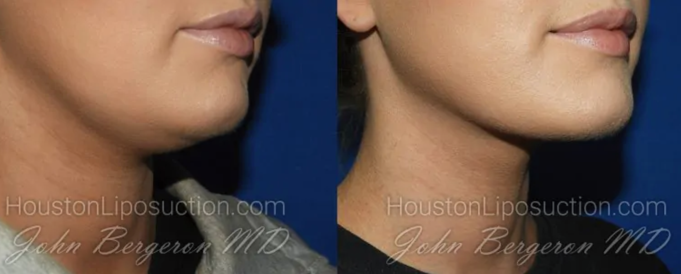 Chin Liposuction Before and After