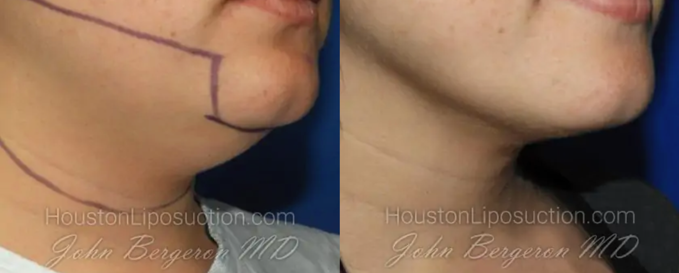 Houston Chin Liposuction Patient