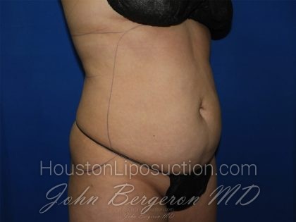 Abdomen Before & After Patient #3639