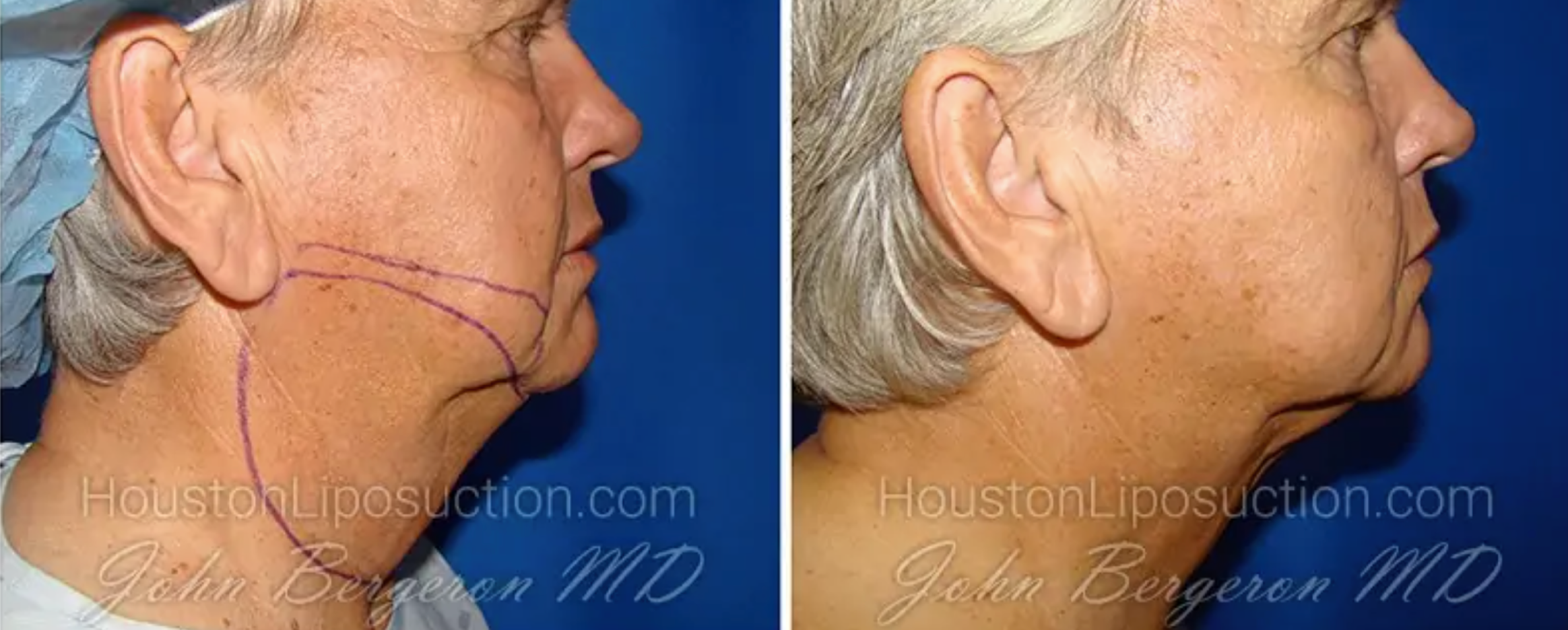 Chin Liposuction Before and After
