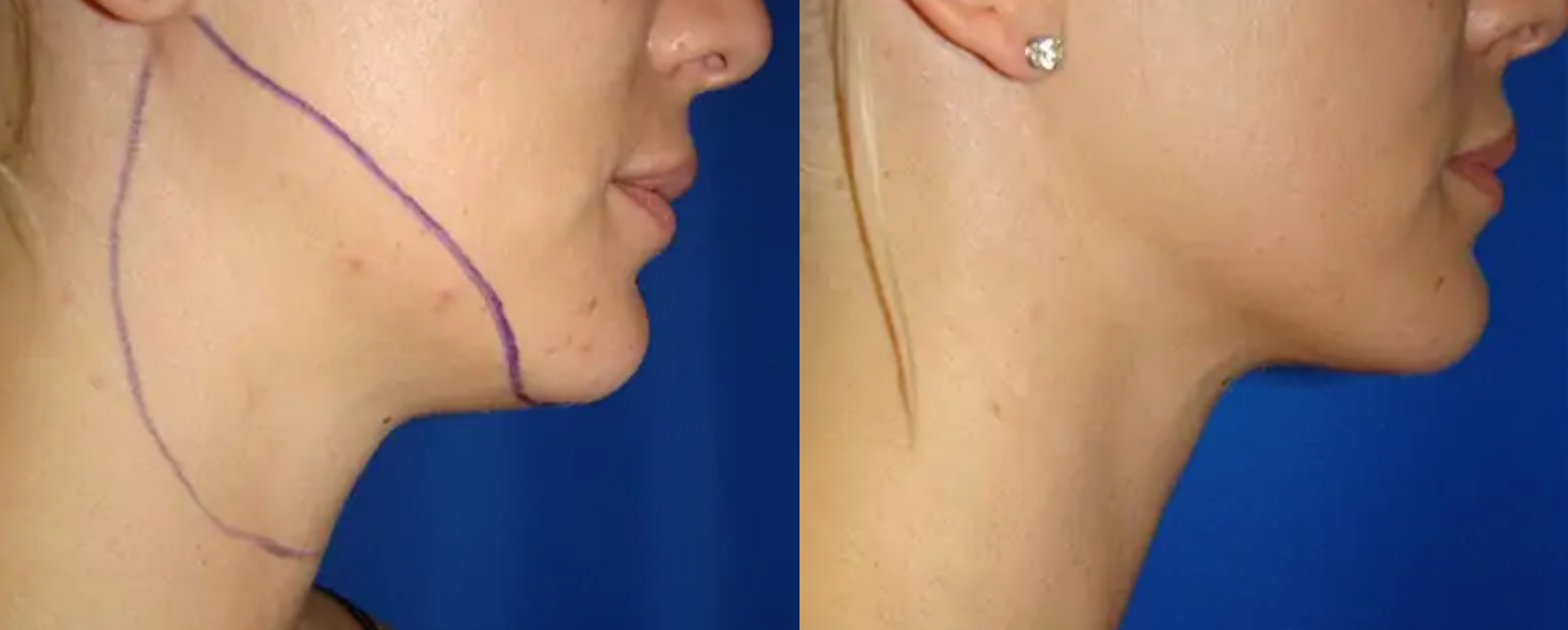 Chin Liposuction Before and After
