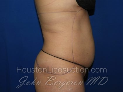 Abdomen Before & After Patient #3639