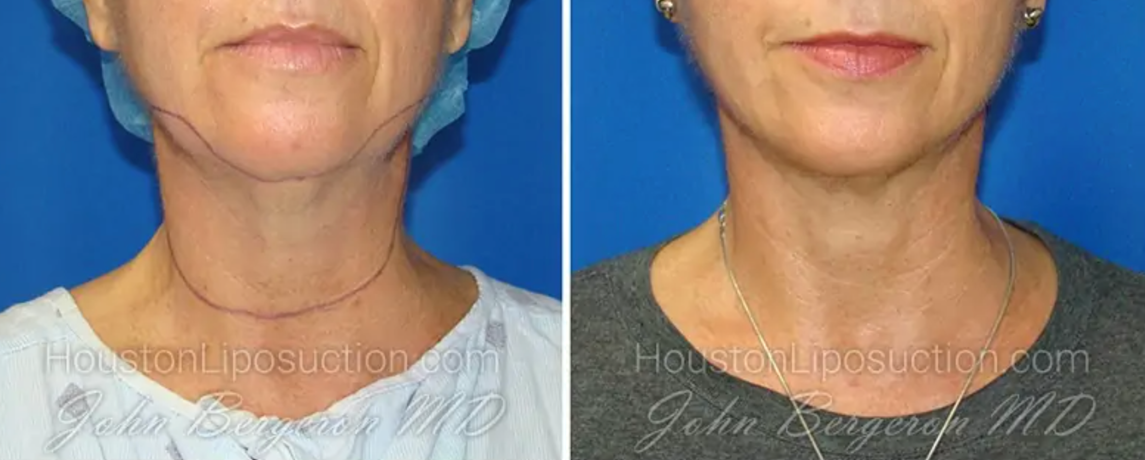 Chin Liposuction Before and After
