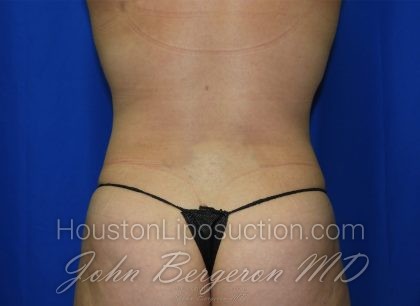 Abdomen Before & After Patient #3639